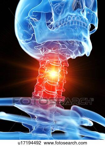 Stock Image - Neck pain, conceptual illustration. Fotosearch