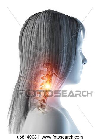 Neck pain, conceptual illustration View Large Photo Image Stock Image - Neck pain, conceptual illustration. Fotosearch