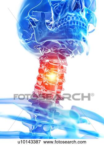 Stock Photo - Neck pain, conceptual illustration. Fotosearch
