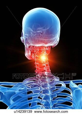 Stock Photo - Neck pain, conceptual illustration. Fotosearch