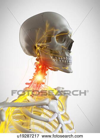 Stock Photo - Neck pain, conceptual illustration. Fotosearch