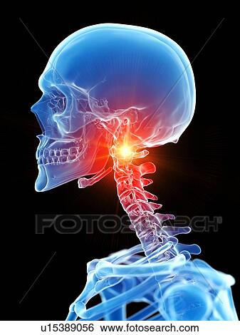 Stock Photograph - Neck pain, conceptual illustration. Fotosearch