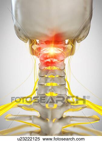 Stock Photography - Neck pain, conceptual illustration. Fotosearch