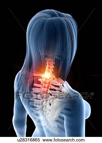 Neck pain, conceptual illustration View Large Photo Image Stock Photography - Neck pain, conceptual illustration. Fotosearch