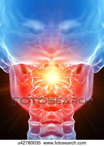 Stock Photography - Neck pain, conceptual illustration. Fotosearch