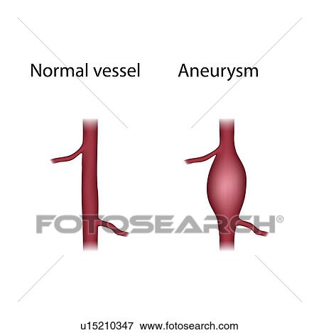 Normal vessel and aneurysm, illustration View Large Photo Image Stock Photo - Normal vessel and aneurysm, illustration. Fotosearch
