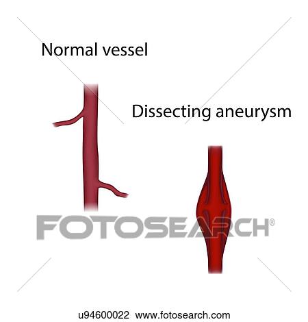 Stock Image - Normal vessel and dissecting aneurysm, illustration. Fotosearch