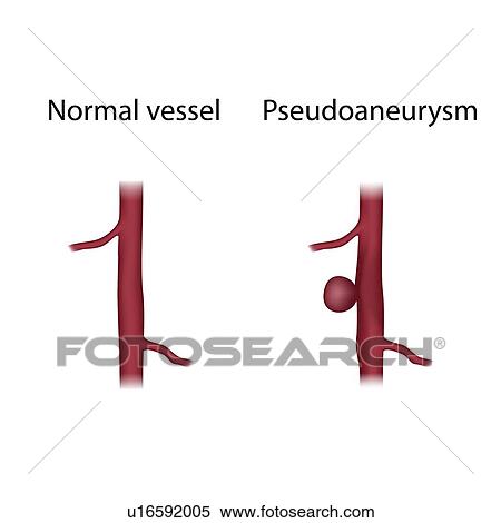 Stock Photography - Normal vessel and pseudoaneurysm, illustration. Fotosearch