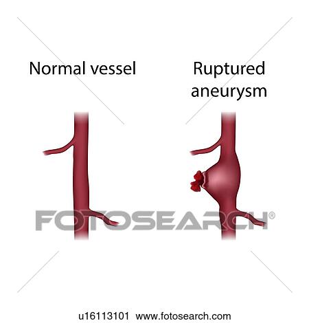 Normal vessel and ruptured aneurysm, illustration View Large Photo Image Stock Image - Normal vessel and ruptured aneurysm, illustration. Fotosearch