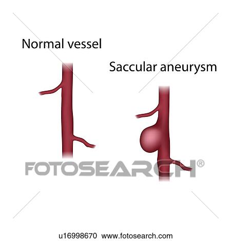 Normal vessel and saccular aneurysm, illustration View Large Photo Image Stock Image - Normal vessel and saccular aneurysm, illustration. Fotosearch