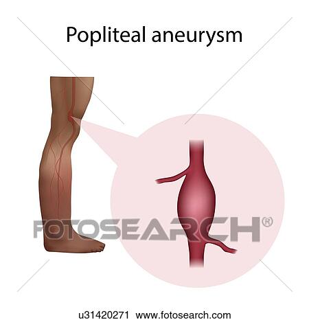 Stock Image - Popliteal aneurysm, illustration. Fotosearch