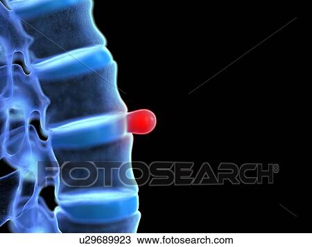 Stock Image - Prolapsed spinal disc, illustration. Fotosearch