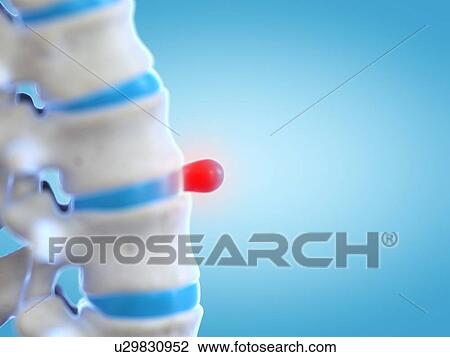 Prolapsed spinal disc, illustration View Large Photo Image Stock Image - Prolapsed spinal disc, illustration. Fotosearch