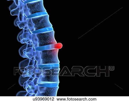 Prolapsed spinal disc, illustration View Large Photo Image Stock Image - Prolapsed spinal disc, illustration. Fotosearch