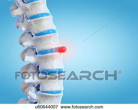 Prolapsed spinal disc, illustration View Large Photo Image Stock Photo - Prolapsed spinal disc, illustration. Fotosearch
