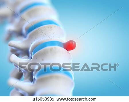 Stock Photography - Prolapsed spinal disc, illustration. Fotosearch