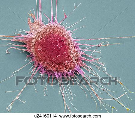 Picture - Prostate cancer cell, SEM. Fotosearch