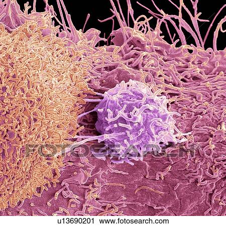 Prostate cancer cells, SEM View Large Photo Image Stock Image - Prostate cancer cells, SEM. Fotosearch