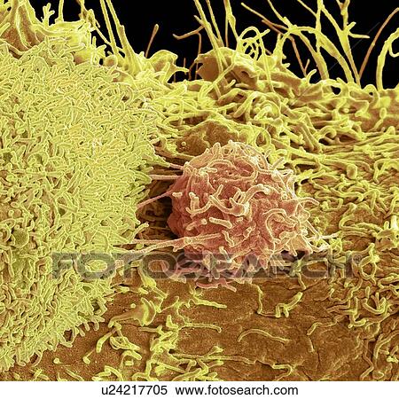 Prostate cancer cells, SEM View Large Photo Image Stock Photography - Prostate cancer cells, SEM. Fotosearch