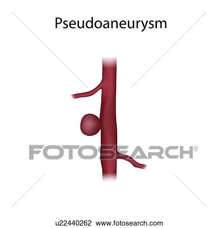 Pseudoaneurysm, illustration View Large Photo Image Stock Image - Pseudoaneurysm, illustration. Fotosearch