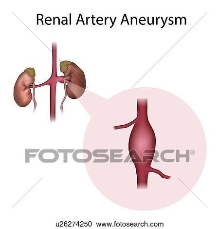 Stock Image - Renal artery aneurysm, illustration. Fotosearch