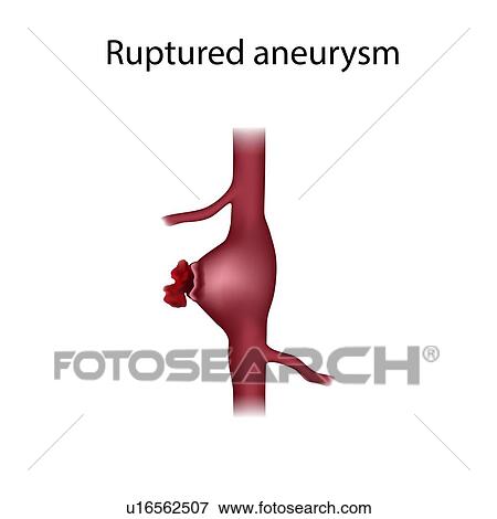 Stock Photo - Ruptured aneurysm, illustration. Fotosearch