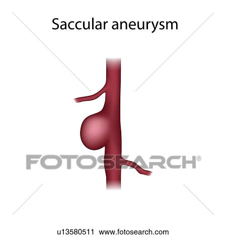 Stock Image - Saccular aneurysm, illustration. Fotosearch