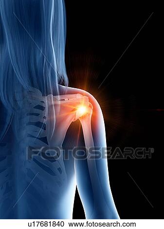 Shoulder pain, conceptual illustration View Large Photo Image Stock Image - Shoulder pain, conceptual illustration. Fotosearch