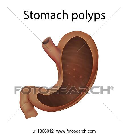 Stomach polyps, illustration View Large Photo Image Stock Image - Stomach polyps, illustration. Fotosearch