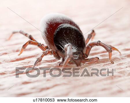 Stock Image - Tick feeding on a human, illustration. Fotosearch