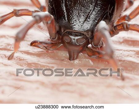 Tick feeding on a human, illustration View Large Photo Image Stock Image - Tick feeding on a human, illustration. Fotosearch