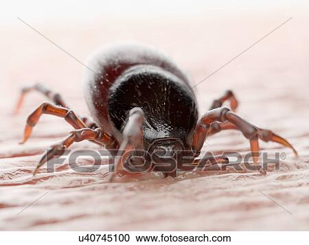 Stock Image - Tick feeding on a human, illustration. Fotosearch