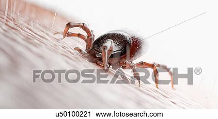 Stock Image - Tick feeding on a human, illustration. Fotosearch