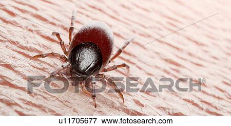Stock Photo - Tick feeding on a human, illustration. Fotosearch