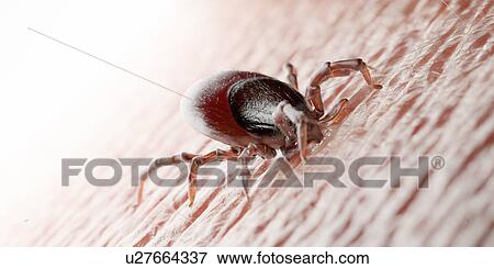 Stock Photo - Tick feeding on a human, illustration. Fotosearch