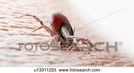 Stock Photography - Tick feeding on a human, illustration. Fotosearch