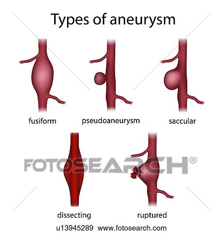 Stock Photo - Types of aneurysm, illustration. Fotosearch