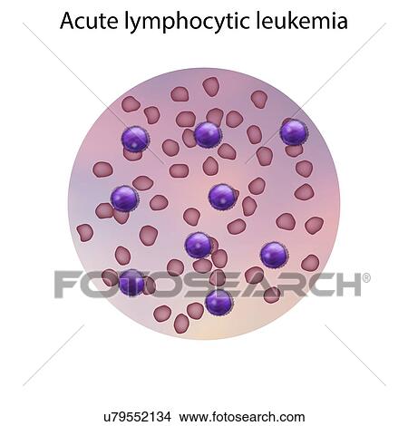 Acute lymphocytic leukaemia, illustration View Large Photo Image Picture - Acute lymphocytic leukaemia, illustration. Fotosearch