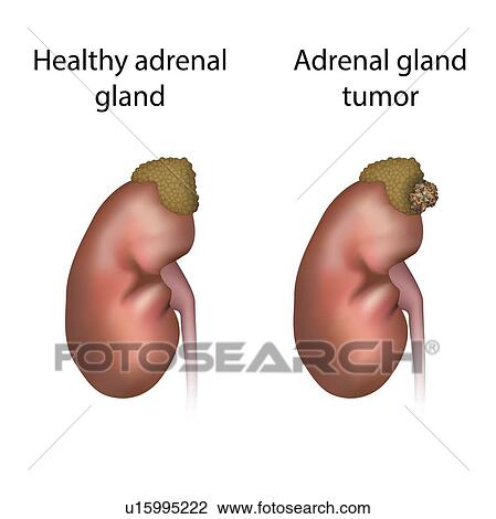 Stock Image - Adrenal gland tumour and healthy adrenal gland, illustration. Fotosearch