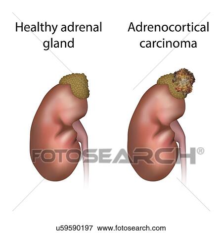 Adrenocortical carcinoma and healthy organ, illustration View Large Photo Image Stock Photo - Adrenocortical carcinoma and healthy organ, illustration. Fotosearch