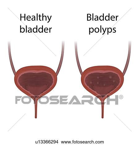 Bladder polyps and healthy bladder, illustration View Large Photo Image Picture - Bladder polyps and healthy bladder, illustration. Fotosearch