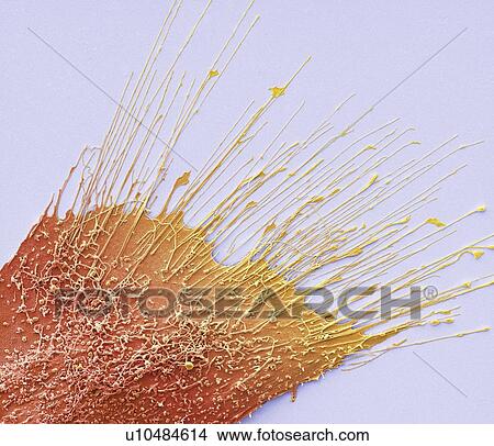 Bone cancer cell, SEM View Large Photo Image Picture - Bone cancer cell, SEM. Fotosearch