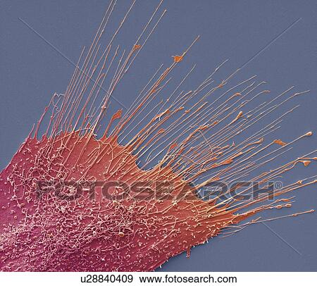 Stock Photo - Bone cancer cell, SEM. Fotosearch