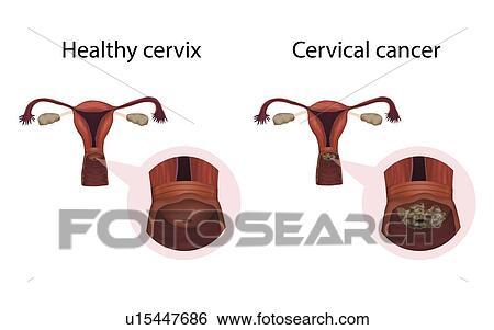 Stock Photograph - Cervical cancer and healthy cervix, illustration. Fotosearch