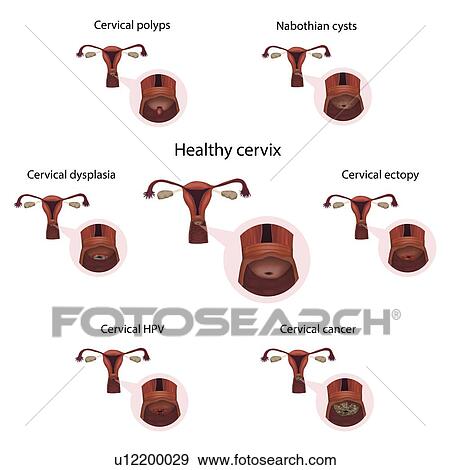 Cervical diseases and healthy cervix, illustration View Large Photo Image Stock Photo - Cervical diseases and healthy cervix, illustration. Fotosearch