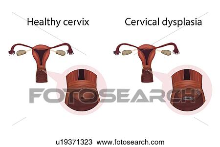Cervical dysplasia and healthy cervix, illustration View Large Photo Image Stock Image - Cervical dysplasia and healthy cervix, illustration. Fotosearch