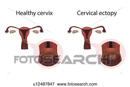 Cervical ectopy and healthy cervix, illustration View Large Photo Image Stock Photo - Cervical ectopy and healthy cervix, illustration. Fotosearch