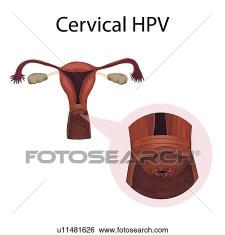 Stock Photograph - Cervical HPV infection, illustration. Fotosearch