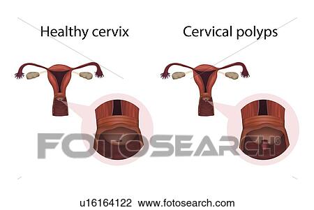 Cervical polyps and healthy cervix, illustration View Large Photo Image Stock Image - Cervical polyps and healthy cervix, illustration. Fotosearch