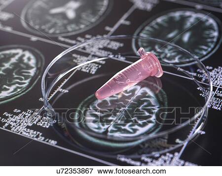 Stock Photo - Clinical samples from research project contained in vials with brain scan images, research into Alzheimers and dementia medical conditions.. Fotosearch